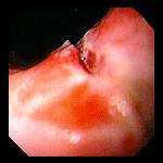 S. di Mallory-Weiss lesione mucosa esofagea acuta lineare secondaria al vomito 1.