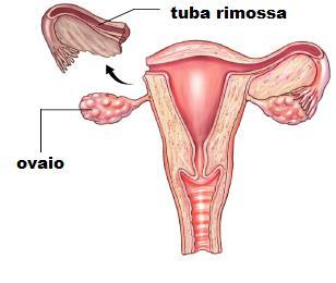 costante da parte del chirurgo, ma è sempre la prima scelta dei chirurghi che lavorano in questo reparto, per le irrinunciabili ricadute positive sulla qualità della degenza e della convalescenza.