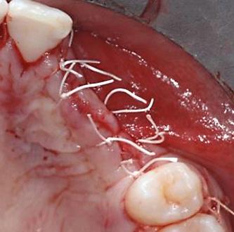 guida nel posizionamento implantare Tecniche di sutura in implantologia Esercitazione