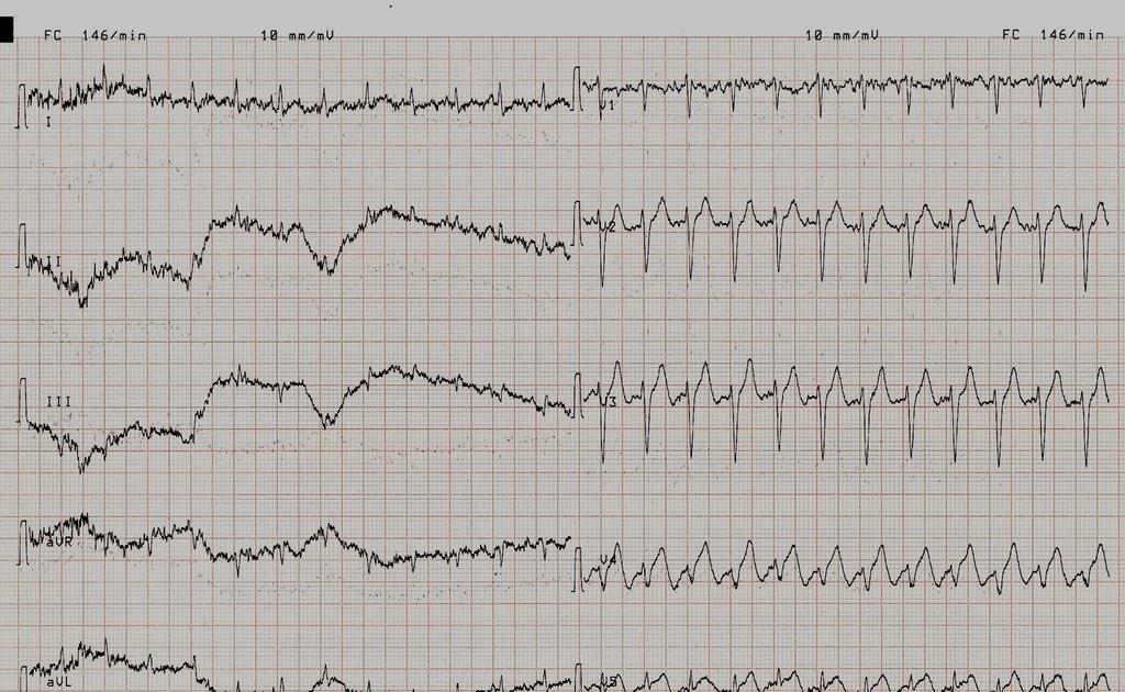 Ecg post PTCA: