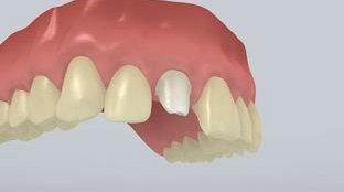 Flowchart SpeedCEM Plus IMPIANTO - Abutment in ossido di zirconio - Corona - Metallo - Moncone ritentiva - Dente antiore - SpeedCEM Plus 1 Situazione iniziale Avvitare l abutment.