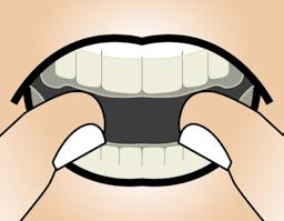 Posizionare sui denti prima il bite della mascella inferiore e in seguito quello della mascella superiore, esercitando una leggera pressione.