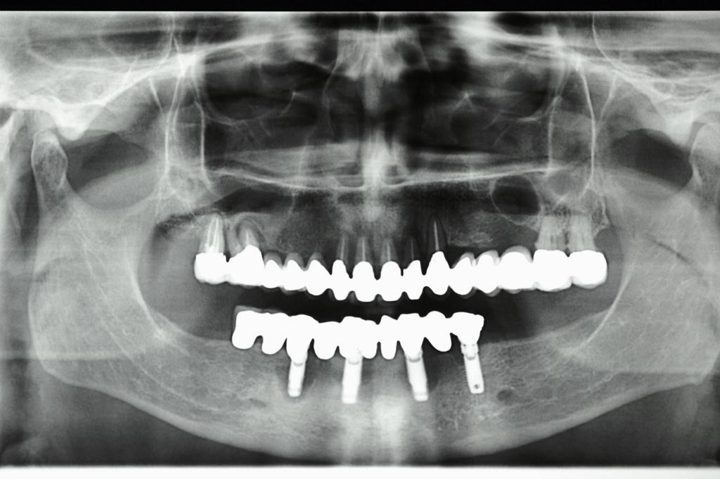 ABUTMENT, TRATTAMENTO DEL