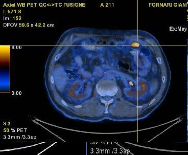 Follow up 2017 Aprile- Maggio (FU 18 mesi) RMN: Sospetta recidiva para-anastomotica PET CT area di intensa