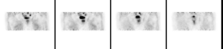 PET/CT con 18F-Colina Protocollo non ottimizzato Per evitare tale interferenza.