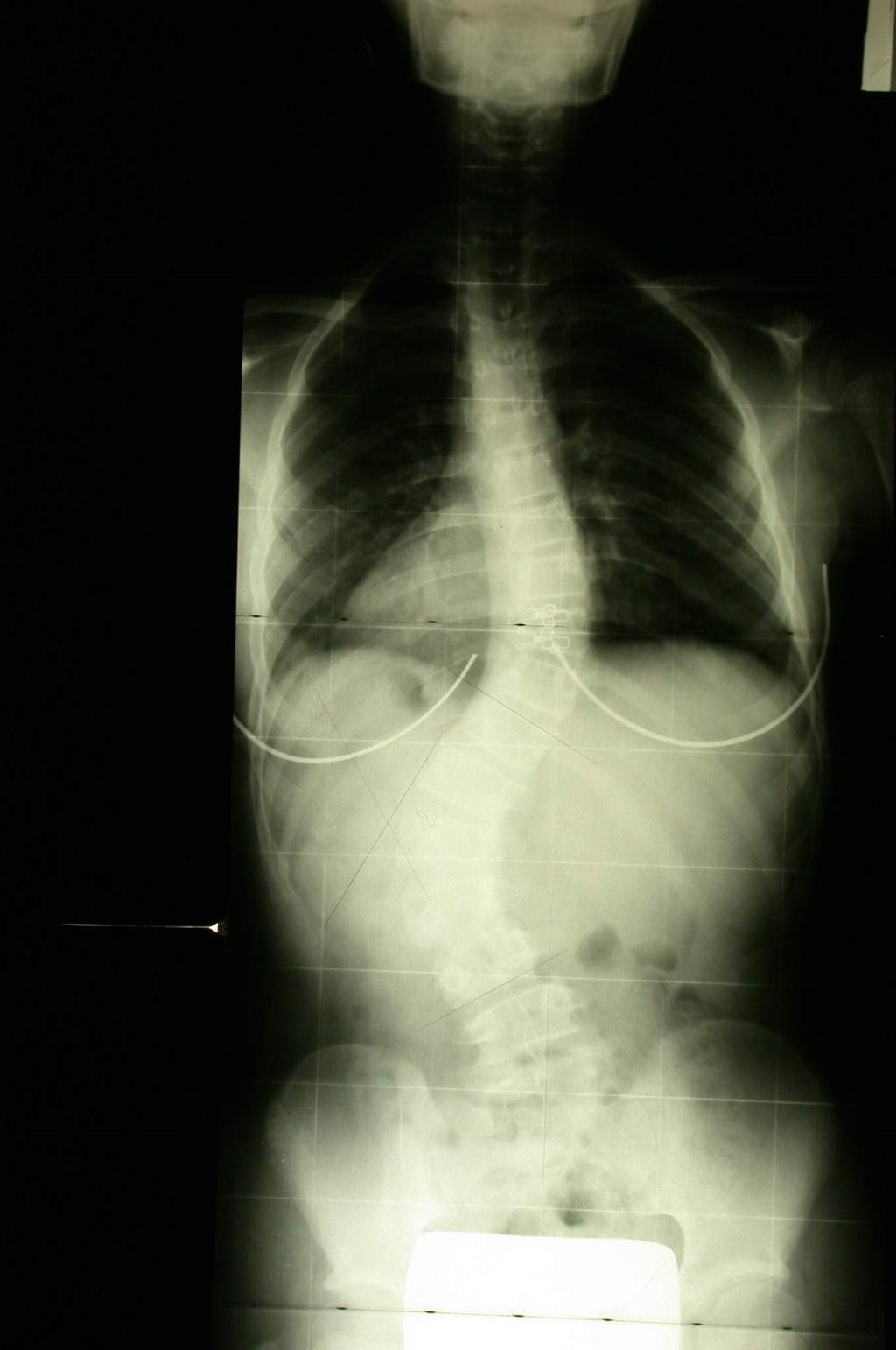 INTERPRETAZIONE IMMAGINI RADIOGRAFICHE Si tracciano due linee passanti per il piatto sup. ed inf.