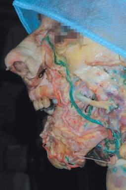Mandibola posteriore e tessuti molli circostanti Figura. Dissezione su cadavere. B-C.