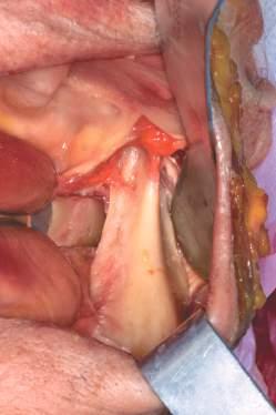 Capitolo ) arteria retromolare; ) arteria alveolare