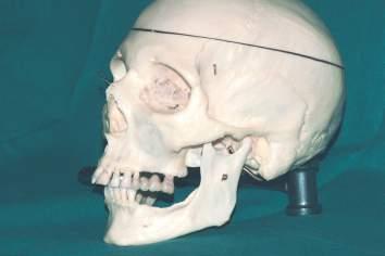 CAPITOLO Mandibola posteriore e tessuti molli circostanti La mandibola posteriore è la parte di mandibola che si trova posteriormente al forame mentoniero.