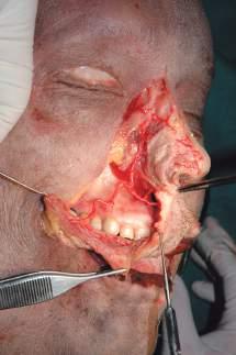 L arteria faciale si trova molto vicino al piano osseo della mandibola e