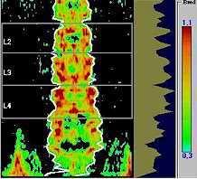 MINERALOMETRIA OSSEA (MOC) In età pediatrica la valutazione della densità ossea viene effettuata sulle prime 4 vertebre lombari (L1-L4).