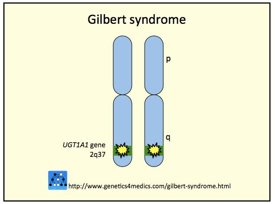 Sindrome di Gilbert Iperbilirubinemia, non-coniugata, in assenza di emolisi o malattie epatiche Ittero intermittente, scatenato da stress, fatica, tipo di alimentazione etc.