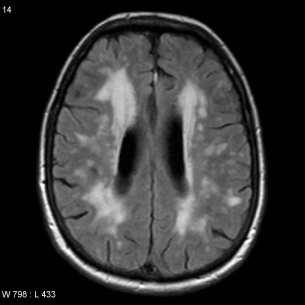 Demenza vascolare Demenza non-degenerativa, causata da una cronica insufficienza dell apporto vascolare Infarti multipli e completi nei territori di distribuzione dei grossi vasi