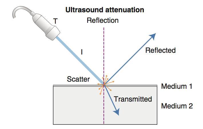 ARTEFATTI DA ATTENUAZIONE Perdita di energia acustica che avviene quando il suono attraversa i tessuti.