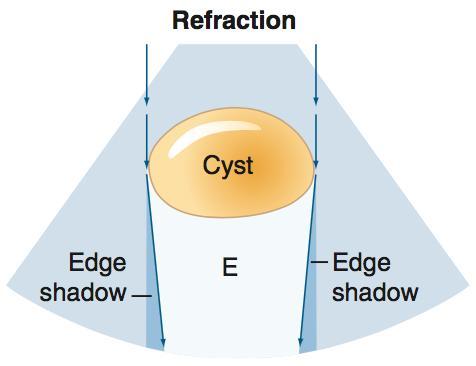 OMBRE ACUSTICHE LATERALI Ombra acustica distalmente ai margini laterali di una struttura cistica ARTEFATTI DA ATTENUAZIONE Nyland & Mattoon, 2015 Quando il fascio US colpisce il margine di una