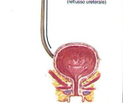 Questo comporta la comparsa di residuo post minzionale da incompleto svuotamento vescicale ed un aumento della pressione endovescicale, che si ripercuote