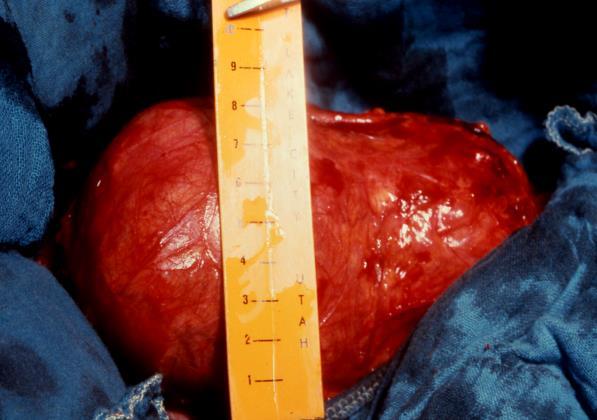 Nel caso di aneurisma dell aorta addominale (AAA), attualmente l indicazione al trattamento in elezione si pone per aneurismi di diametro superiore ai 5.
