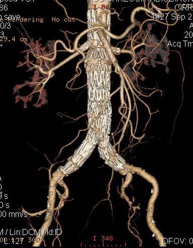 livello iliaco (comune od esterna in caso non sia possibile limitare il trattamento al di sopra dell emergenza delle arterie ipogastriche in caso di aneurismi estesi aorto-iliaci).