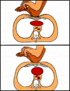 Fase C Compressioni Toraciche Esterne PROFONDITA 2-3 CM FREQUENZA