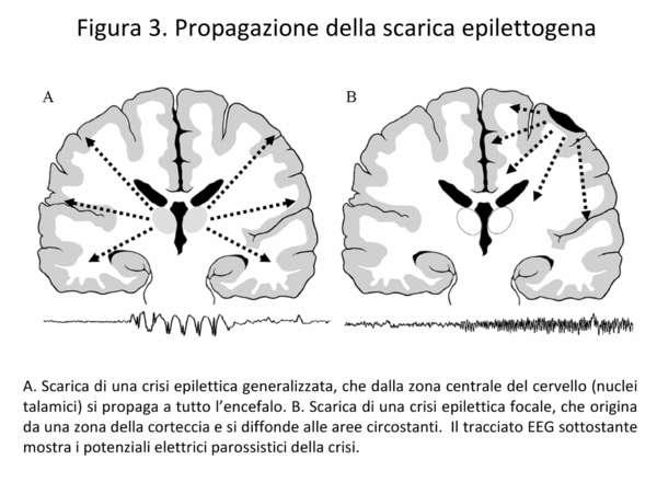 FISIOPATOLOGIA Dal concetto di focolaio epilettogeno si è ora passati al concetto di circuito o network.