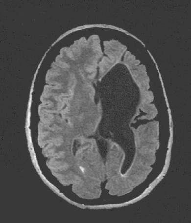 HYPOTHETICAL CASE: Stroke & Seizure A 65 year-old man had a left middle cerebral artery stroke 6 weeks ago and now presented with an unprovoked seizure.