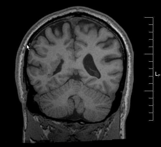 dysplasia Comment: Although many clinicians would reasonably treat this man with anti-seizure medications, the