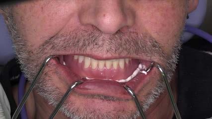 13 Inserire la protesi inferiore completa nel cavo orale del paziente e verificare l'assenza di gioco.