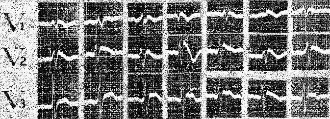 Fig. 1. Electrocardiogram of a 39-year-old white male with mild atypical chest pain but no clinical evidence of heart disease. Note the wide QRS interval (0.12-0.