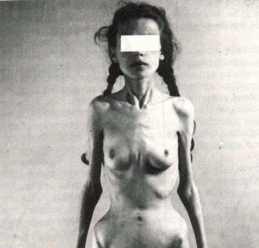 Anoressia nervosa - quadro endocrino Asse