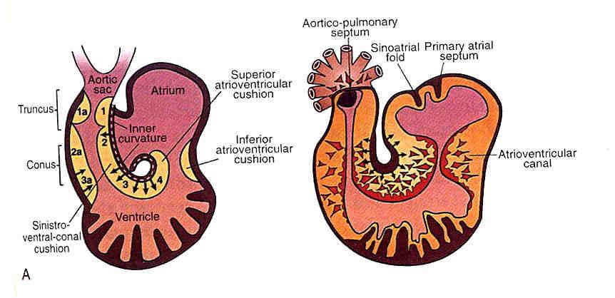 Difetti del canale atrio-ventricolare Spettro di malformazioni dovute ad anomalie di sviluppo dei cuscinetti endocardici che