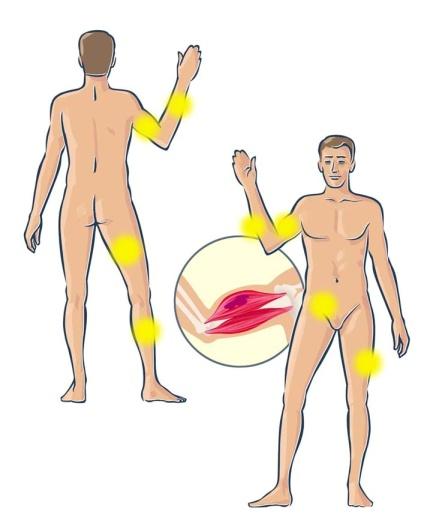 orale Emartri Ematomi muscolari Anemizzazione Evoluzione in artropatia e sinovite cronica Formazione di pseudotumor o cisti emofilica Sanguinamenti