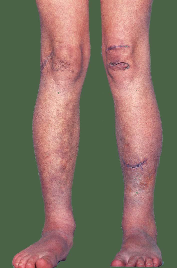 porpora nelle cicatrici, specialmente intorno alle ginocchia;