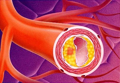 Occlusione delle arterie cerebrali trombosi cerebrale: 434.0_ embolia cerebrale: 434.