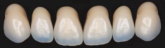 O Denti Anteriori Superiori Forme Ovali Denti Anteriori Inferiori O33 9.5 L3 8.1 43.5 7.