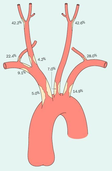 CONSENSO INFORMATO TRATTAMENTO CHIRURGICO/ENDOVASCOLARE DELLA PATOLOGIA CAROTIDEA DEFINIZIONE: la malattia cerebrovascolare è la seconda causa di morte cardiovascolare ed è una patologia che