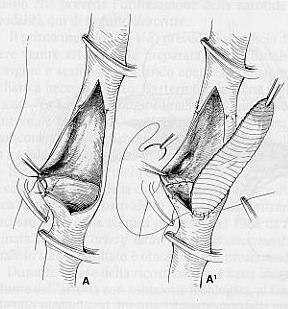 Pertanto la decisione se correggere o meno una stenosi delle arterie extracraniche avviene dopo la valutazione dei caratteri della lesione stessa e mediante tutte le indagini necessarie a scoprire o