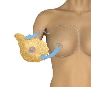 La Mastectomia Sottocutanea con risparmio di cute Anche detta Skin Sparing Mastectomy, è considerata una mastectomia conservativa.