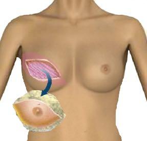 La Mastectomia Semplice E un intervento chirurgico finalizzato alla rimozione del seno insieme con il tumore.