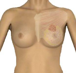 La Mastectomia Allargata La mastectomia allargata è un intervento chirurgico che prevede la rimozione del seno in blocco con il tumore, i linfonodi del cavo ascellare e altre strutture della parete