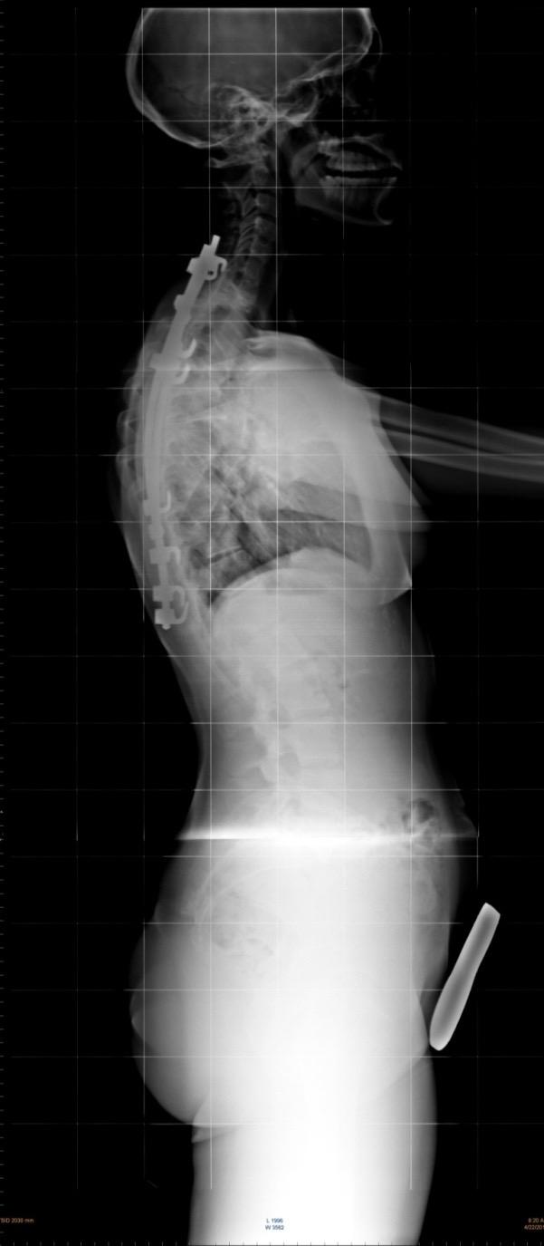 SCOLIOSI SEVERA TRATTATA CHIRURGICAMENTE A 12 ANNI- Attualmente le