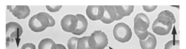 80 µg/dl, si riscontra punteggiatura basofila negli eritrociti, dovuta ad aggregazione