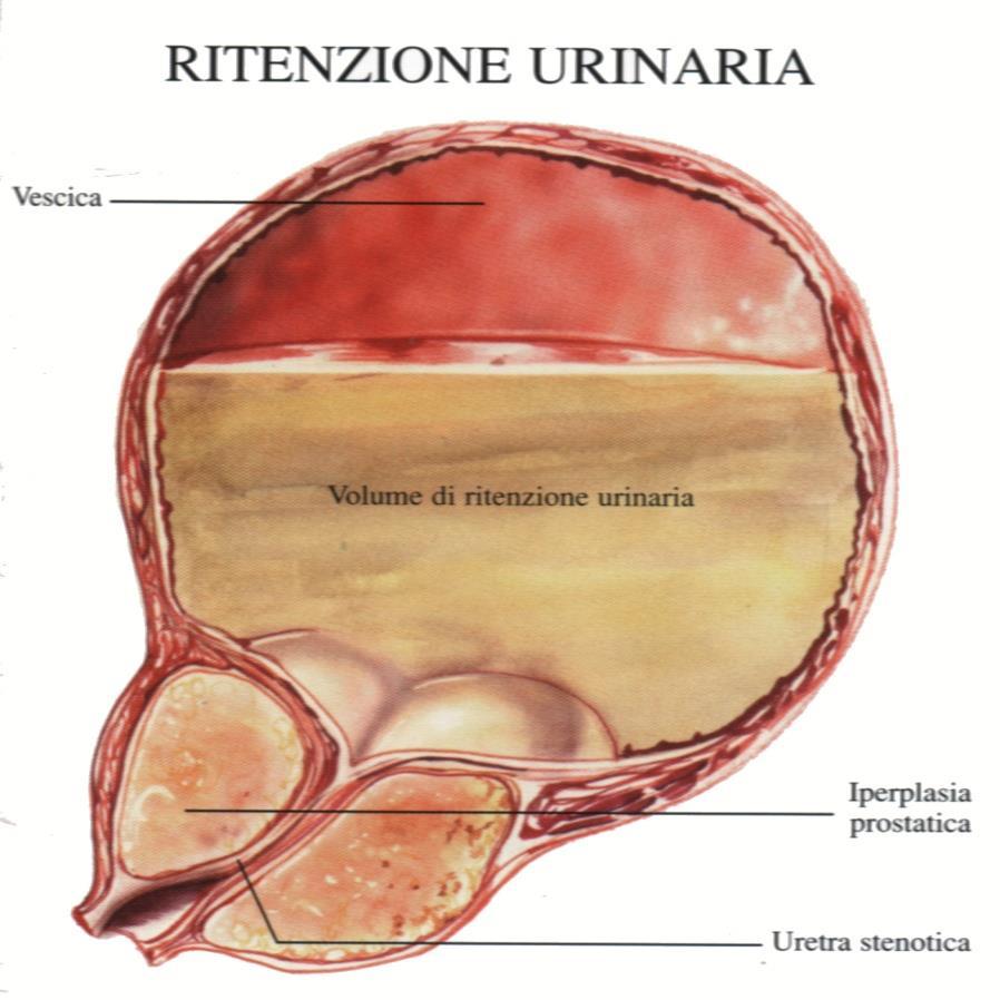 Cosa causa l Iperplasia Prostatica Benigna (IPB)?