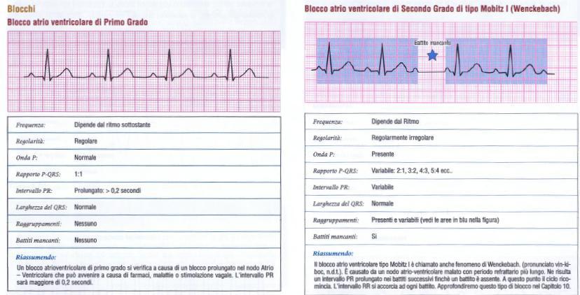 INTERVALLO P-R > DI 0,2 sec.