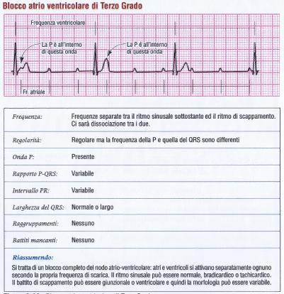 ATRIALE (2:1) COMPLETA ASSENZA DELLA CONDUZIONE AI VENTRICOLI DEGLI