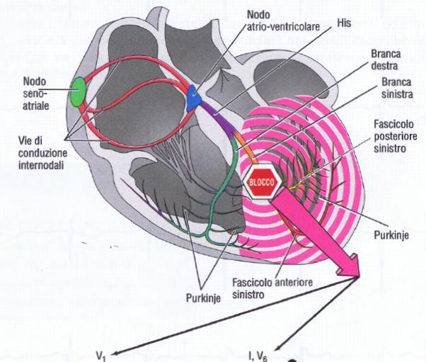 BLOCCO DI BRANCA SINISTRA (BBSX) Il blocco di branca sinistro (BBS) è una anormalità della conduzione cardiaca in cui si ha l'attivazione del ventricolo sinistro che è