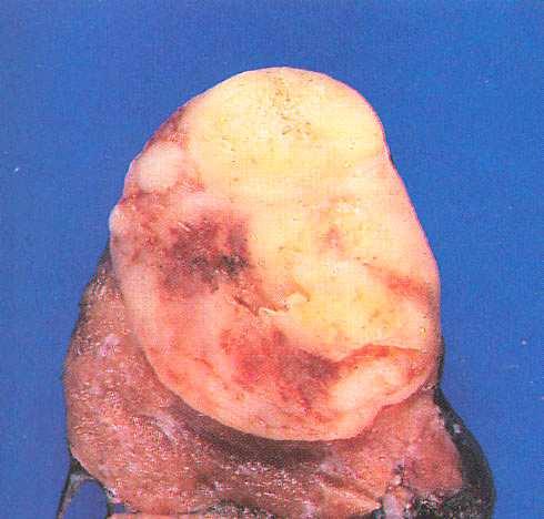 carcinoma