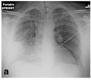 Dopo 2 ore di trattamento con CPAP: ph 7.