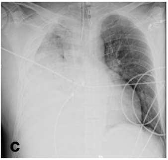 dall ingresso e 4 l di fisiologica Controllo Rx a