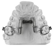 in testa permette un inserzione facile e precisa di qualsiasi apparecchiatura ortodontica Vantaggi: Possibile e raccomandato carico immediato