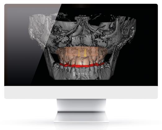 PROGRAMMAZIONE CON SOFTWARE EASY DR IVER E SOVRAPPOSIZIONE TRA MODELLO E CBCT Visualizzazione tramite la CBCT del posizionamento ideale del sito per miniviti virtuali BENEfit Visualizzazione volume